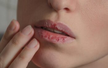 Jangan Sampai Salah! 6 Penyebab Bibir Kering yang Sering Diabaikan