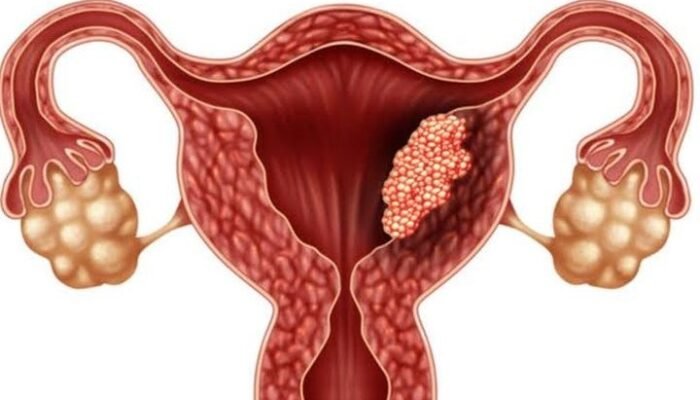 Waspadai Kanker Serviks: Ancaman Nyata bagi Kesehatan Reproduksi Wanita
