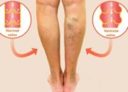 Pembuluh darah menonjol| Sumber: medicastrore.com