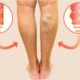 Pembuluh darah menonjol| Sumber: medicastrore.com