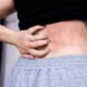 Alergi Kulit Faktor Pemicu Gejala dan Cara Pencegahan| Sumber: istockphoto.com
