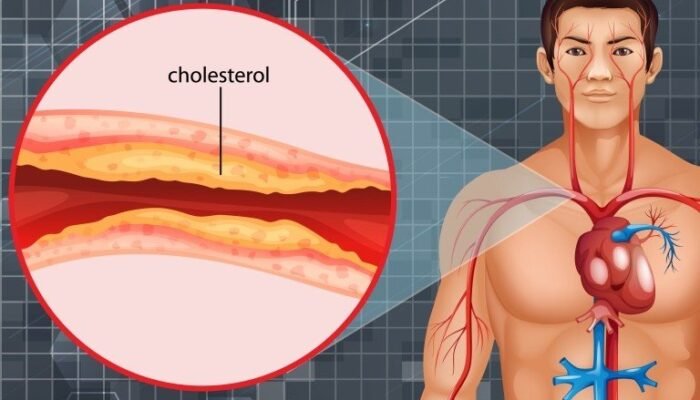 Kolesterol Baik vs Kolesterol Jahat: Mana yang Lebih Dominan di Tubuh Anda?