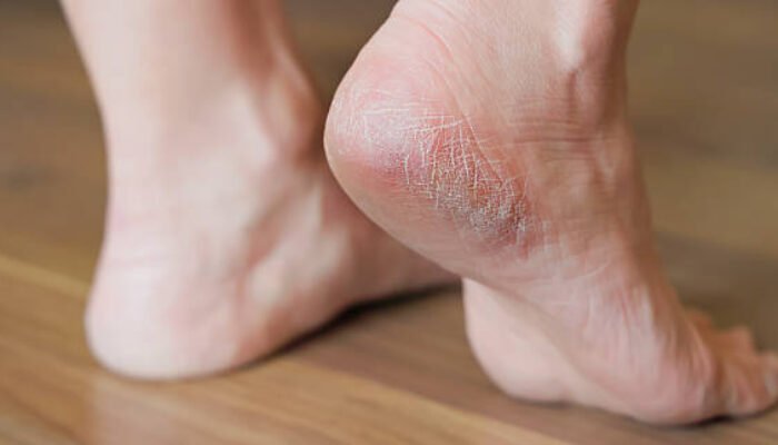 Kulit Kaki Kering dan Pecah-Pecah Begini Cara Ampuh Mengatasi dan Mencegahnya