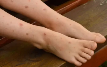 Rahasia Ampuh Memudarkan Bekas Luka Hitam Secara Alami dan Medis | Sumber: Liputan6.com