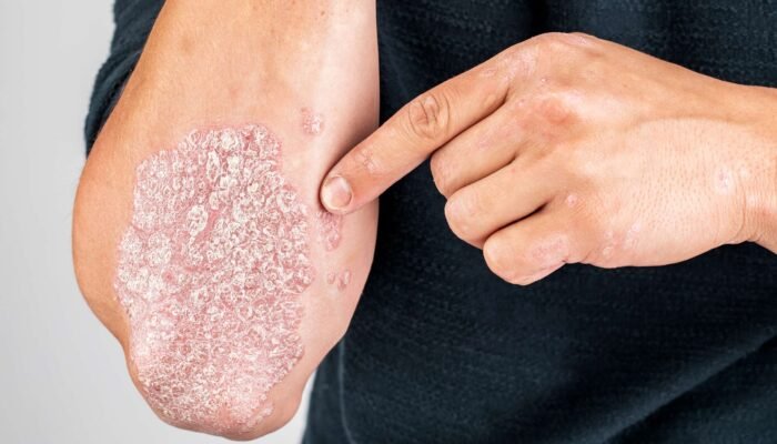 Mengenal Psoriasis: Penyakit Autoimun Kulit Yang Sering Di Salah Pahami