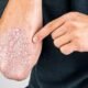 Psoriasis: Saat Sistem Imun Justru Menyerang Kulit Sendiri | Sumber: C Derma