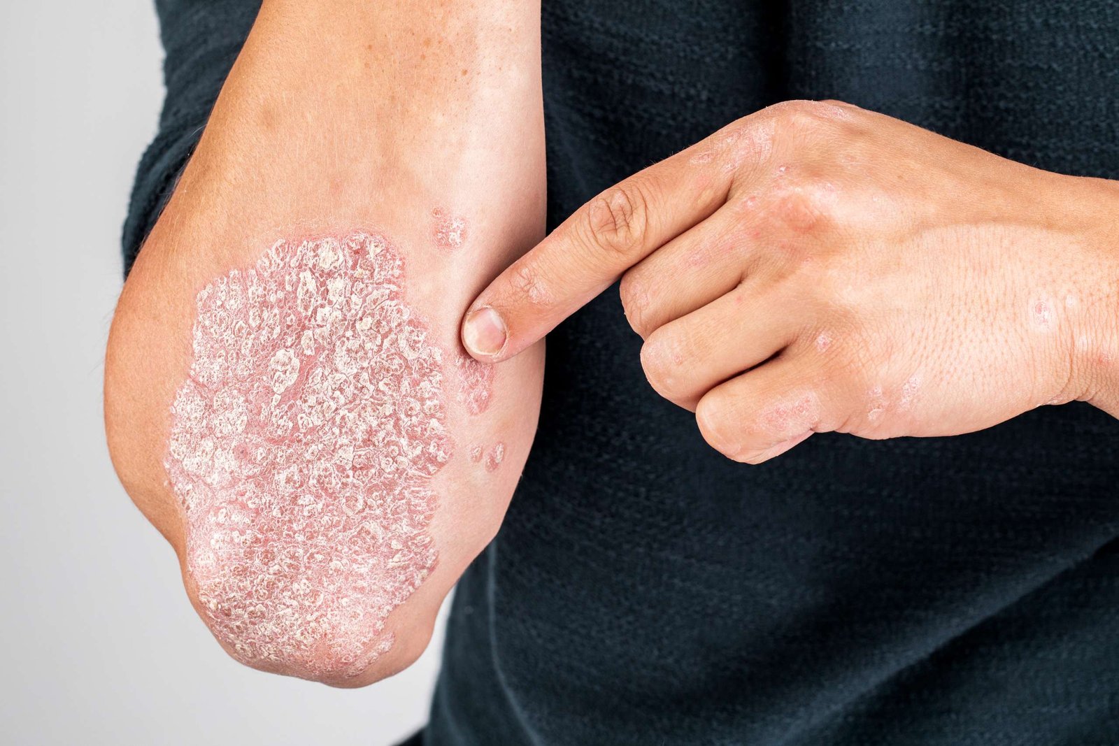 Psoriasis: Saat Sistem Imun Justru Menyerang Kulit Sendiri | Sumber: C Derma