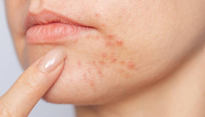 Kulit Terasa Kasar dan Penuh Bintik Kecil? Kenali Bruntusan dan Cara Mengatasinya