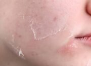 Mengenal Kulit Kering: Penyebab, Gejala, dan Tips Perawatan